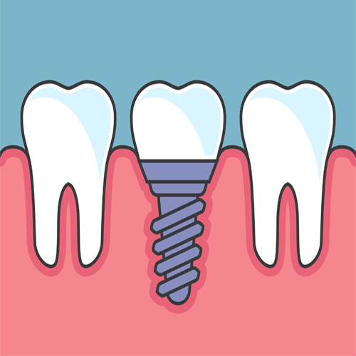 Dental Implants 